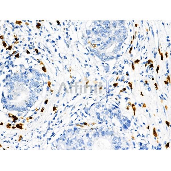 Phospho-R-Ras (Tyr66) Antibody - AF8509 at 1/100 staining Human gastric cancer by IHC-P.