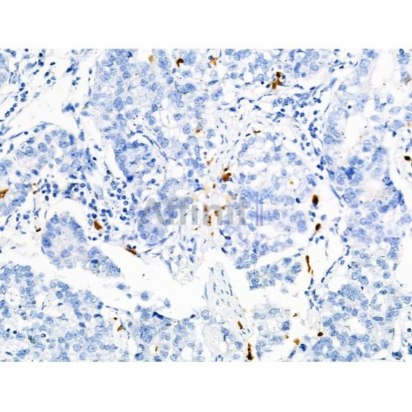 Phospho-R-Ras (Tyr66) Antibody - AF8509 at 1/100 staining Human gastric cancer by IHC-P.