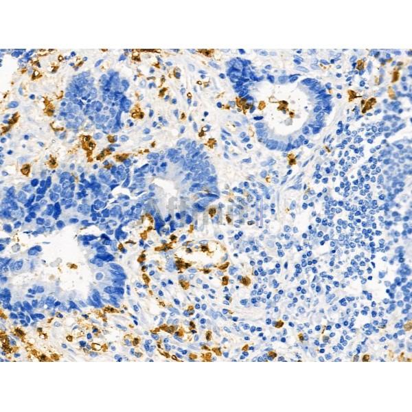 Phospho-R-Ras (Tyr66) Antibody - AF8509 at 1/100 staining Human colorectal cancer by IHC-P.
