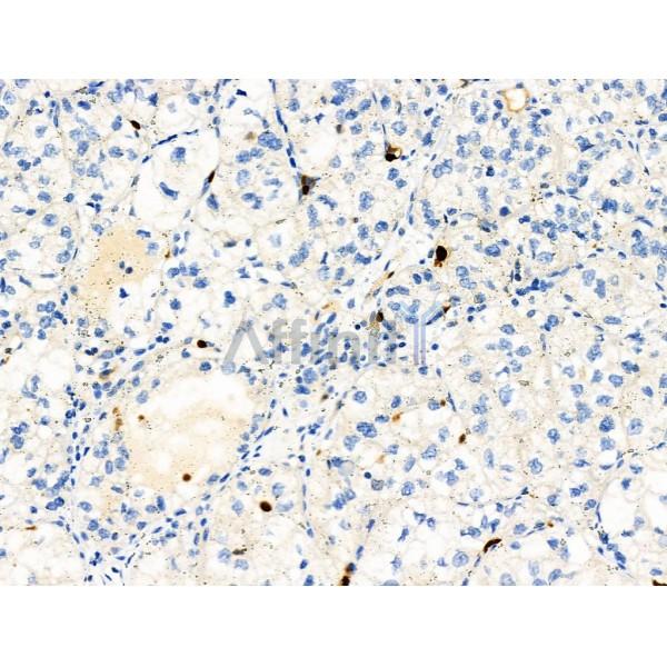 Phospho-R-Ras (Tyr66) Antibody - AF8509 at 1/100 staining Human kidney cancer by IHC-P.