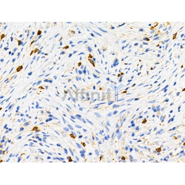Phospho-R-Ras (Tyr66) Antibody - AF8509 at 1/100 staining Human ovarian cancer by IHC-P.