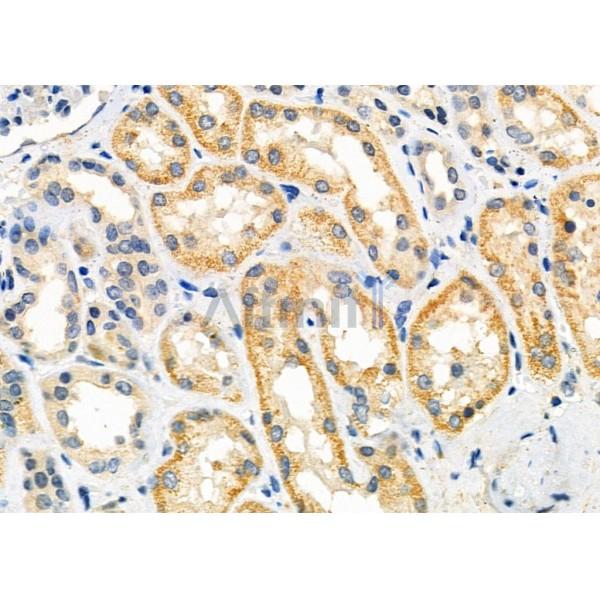 GPR139 Antibody - AF9074 at 1/100 staining Human kidney cancer and adjacent normal tissues by IHC-P.