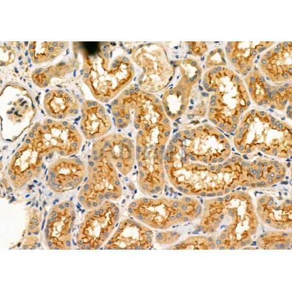 Photomedin-2 Antibody - AF9157 at 1/100 staining Human kidney cancer and adjacent normal tissues by IHC-P.