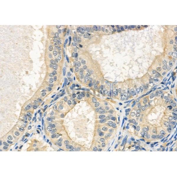 Photomedin-2 Antibody - AF9157 at 1/100 staining Human ovarian cancer and adjacent normal tissues by IHC-P.