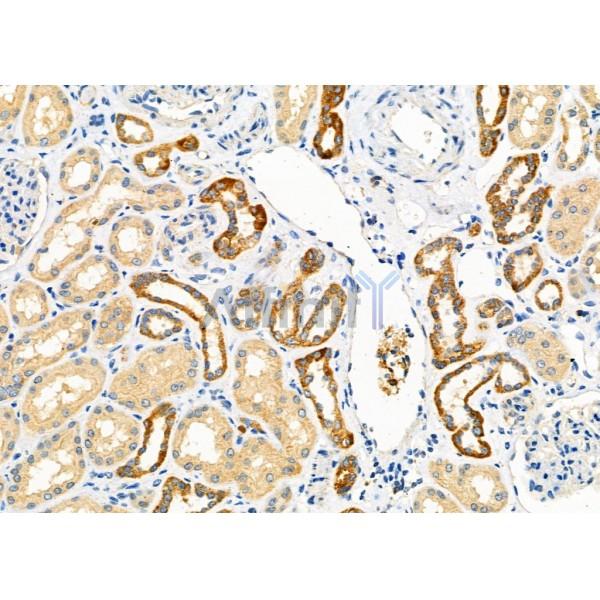 TBL2 Antibody - AF9209 at 1/100 staining Human kidney cancer and adjacent normal tissues by IHC-P.