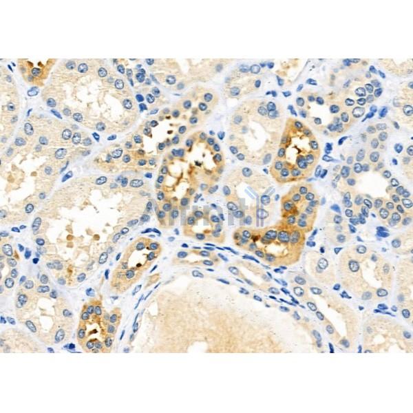USP40 Antibody - AF9224 at 1/100 staining Human kidney cancer and adjacent normal tissues by IHC-P.