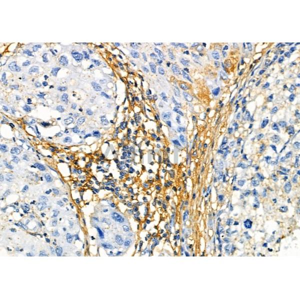 V1RL3 Antibody - AF9226 at 1/100 staining Human pancreatic cancer by IHC-P.