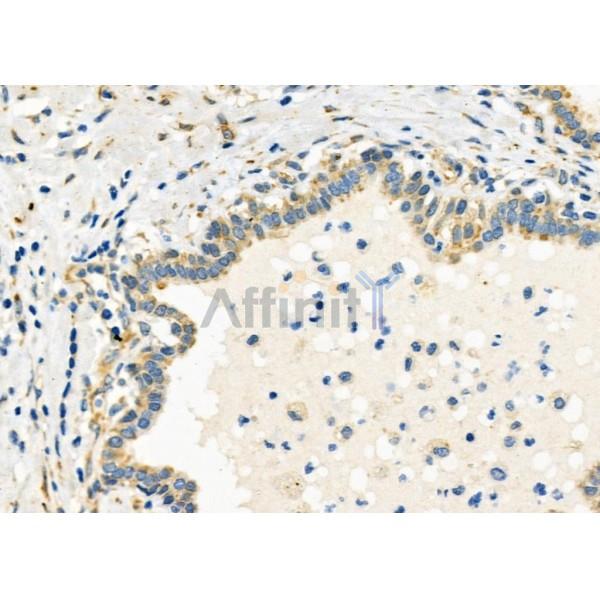 SLC30A2 Antibody - DF10020 at 1/100 staining Human prostate cancer by IHC-P.