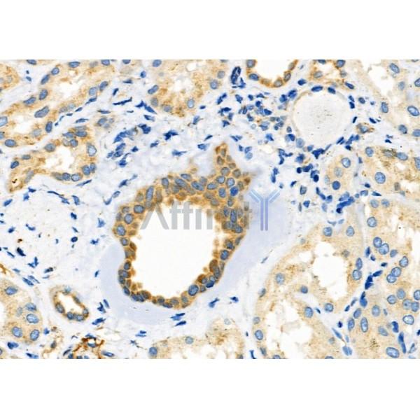 SLC30A2 Antibody - DF10020 at 1/100 staining Human kidney cancer and adjacent normal tissues by IHC-P.