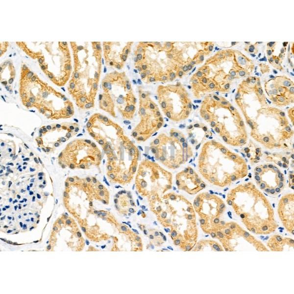 CD164L2 Antibody - DF10023 at 1/100 staining Human kidney cancer and adjacent normal tissues by IHC-P.