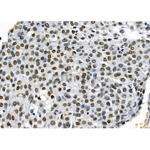 MAGG1 Antibody - DF10042 at 1/100 staining Human esophageal cancer by IHC-P.