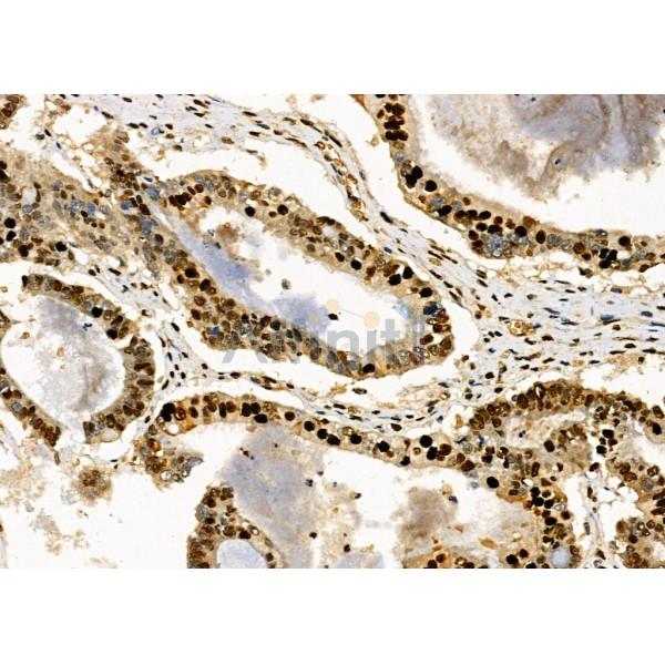 MAGG1 Antibody - DF10042 at 1/100 staining Human ovarian cancer by IHC-P.