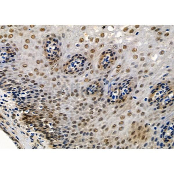 HEN2 Antibody - DF10046 at 1/100 staining Human esophageal cancer and adjacent normal tissues by IHC-P.