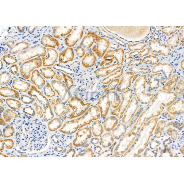 FBF1 Antibody - DF10103 at 1/100 staining Human kidney cancer and adjacent normal tissues by IHC-P.