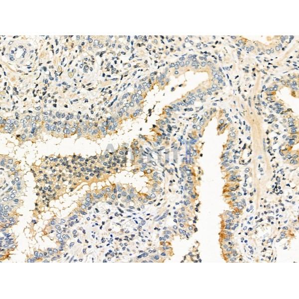 OPSB Antibody - DF10234 at 1/100 staining Human prostate cancer by IHC-P.