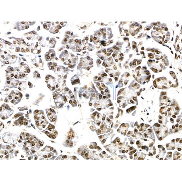 PDP2 Antibody - DF2227 at 1/100 staining Human pancreatic cancer and adjacent nomal tissues by IHC-P.