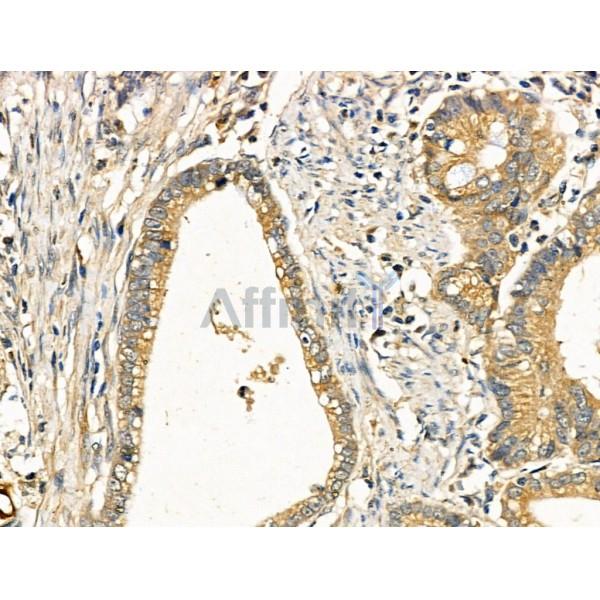 MT-CYB Antibody - DF2372 at 1/100 staining Human gastric cancer by IHC-P.