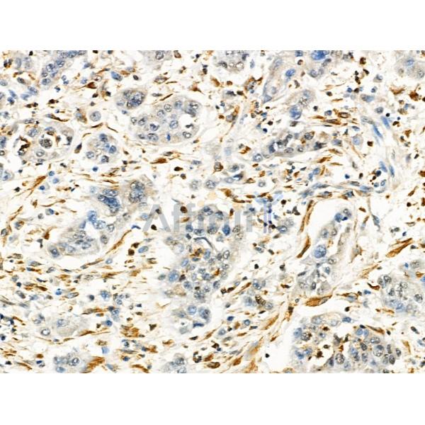 LRRC41 Antibody - DF4138 at 1/100 staining Human gastric cancer by IHC-P.