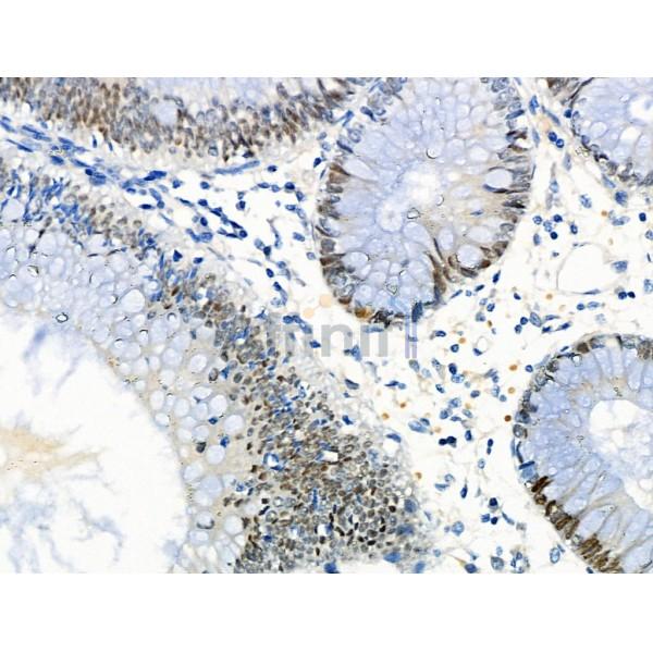 LRRC41 Antibody - DF4138 at 1/100 staining Human colorectal cancer and adjacent normal tissues by IHC-P.