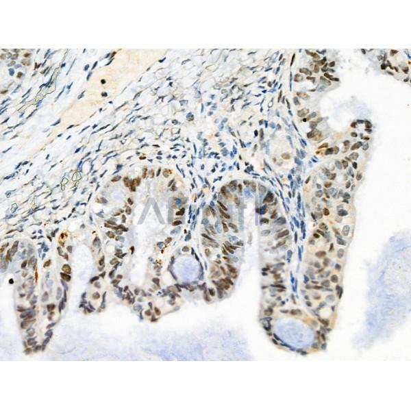 LRRC41 Antibody - DF4138 at 1/100 staining Human ovarian cancer by IHC-P.