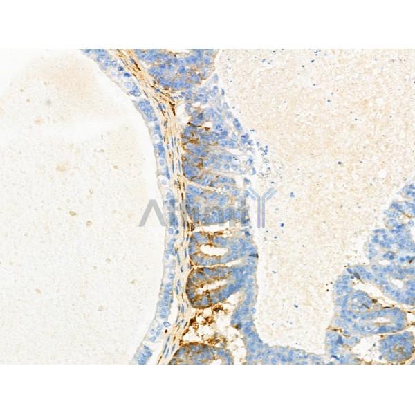 MEGF9 Antibody - DF4188 at 1/100 staining Human ovarian cancer by IHC-P.