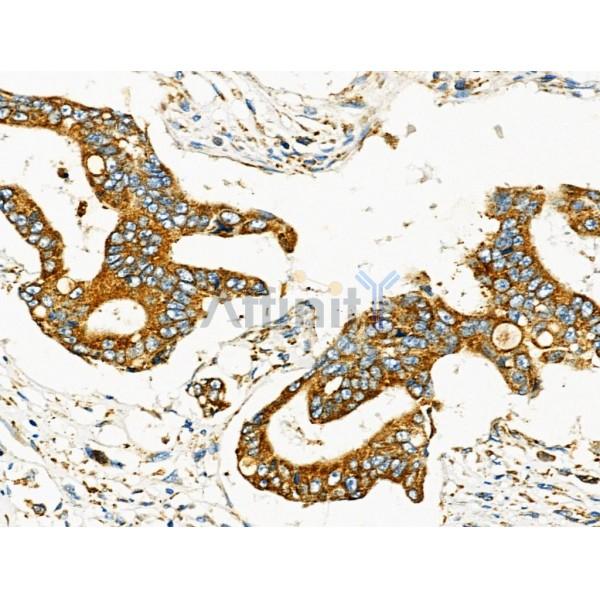 MOV10L1 Antibody - DF4361 at 1/100 staining Human colorectal cancer by IHC-P.