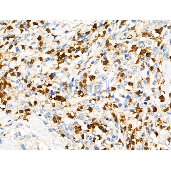RGS1 Antibody - DF4413 at 1/100 staining Human esophageal cancer by IHC-P.