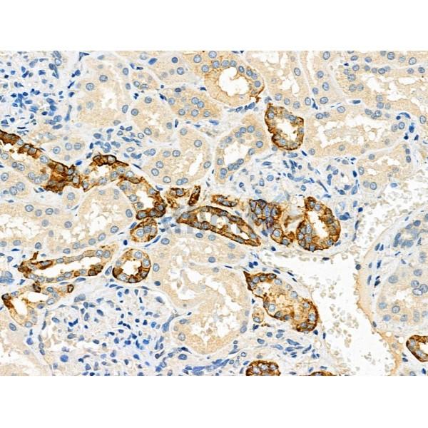 DVL3 Antibody - DF4455 at 1/100 staining Human kidney cancer and adjacent normal tissues by IHC-P.