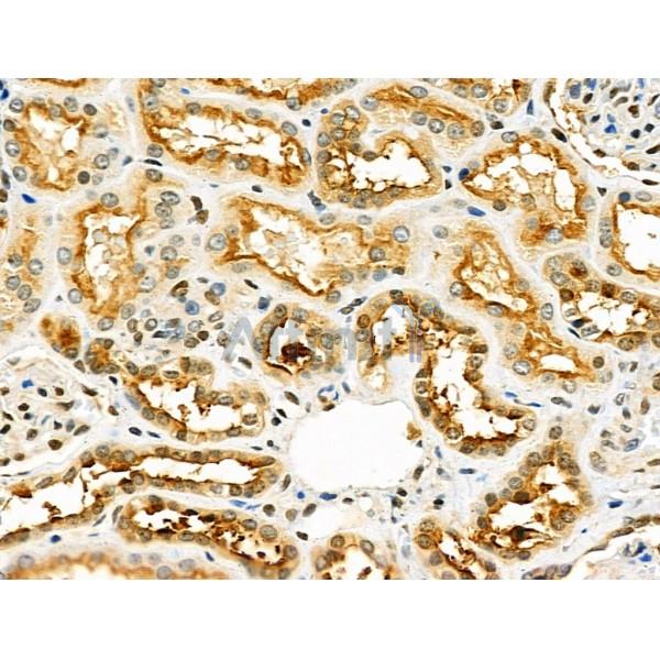 ZP4 Antibody - DF4642 at 1/100 staining Human kidney cancer and adjacent normal tissues by IHC-P.