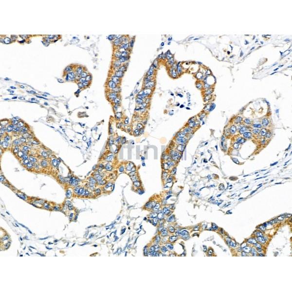 NDFIP1 Antibody - DF4681 at 1/100 staining Human colorectal cancer by IHC-P.