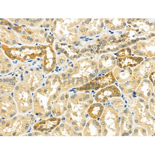 NDFIP1 Antibody - DF4681 at 1/100 staining Human kidney cancer and adjacent normal tissues by IHC-P.
