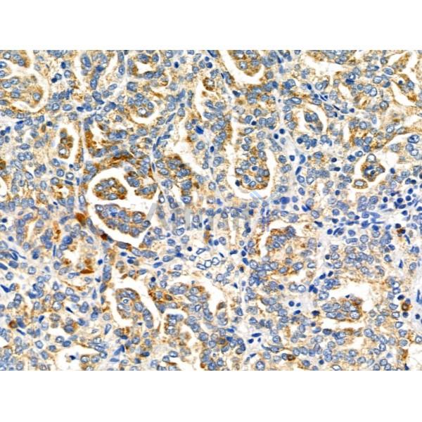 NDFIP1 Antibody - DF4681 at 1/100 staining Human kidney cancer by IHC-P.