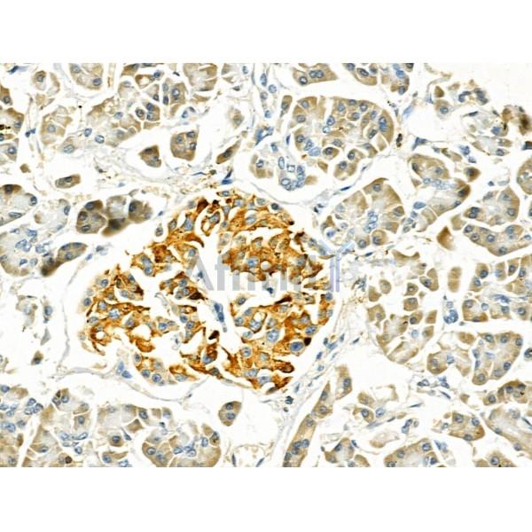 MYL3 Antibody - DF4717 at 1/100 staining Human pancreatic cancer and adjacent nomal tissues by IHC-P.