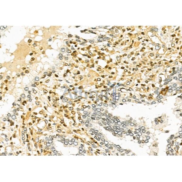 TAIP-2 Antibody - DF4726 at 1/100 staining Human prostate cancer by IHC-P.