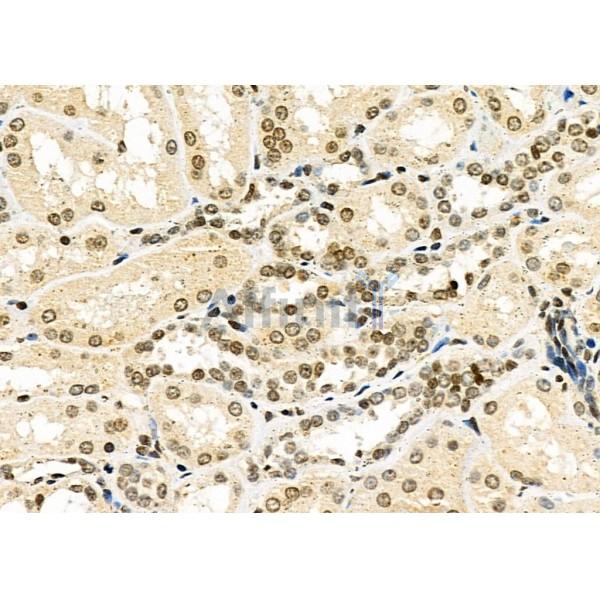 TAIP-2 Antibody - DF4726 at 1/100 staining Human kidney cancer and adjacent normal tissues by IHC-P.