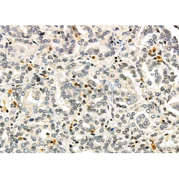 TAIP-2 Antibody - DF4726 at 1/100 staining Human kidney cancer by IHC-P.