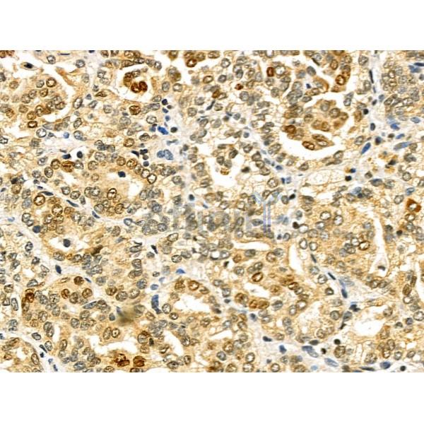 CHFR Antibody - DF4733 at 1/100 staining Human kidney cancer by IHC-P.