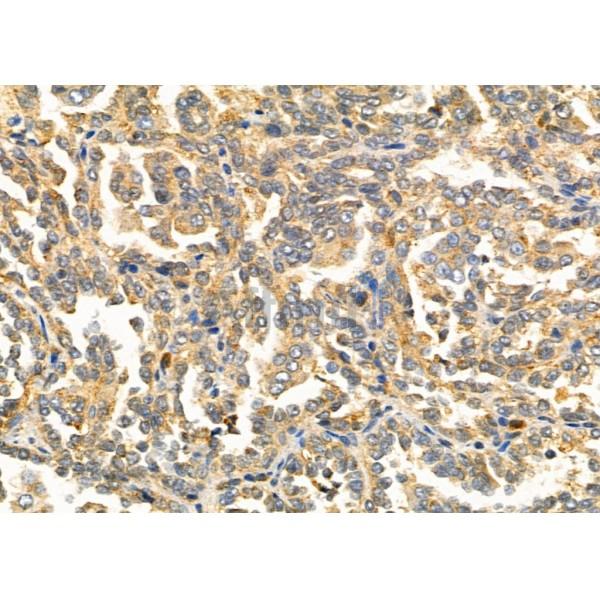 LY75 Antibody - DF4810 at 1/100 staining Human kidney cancer by IHC-P.
