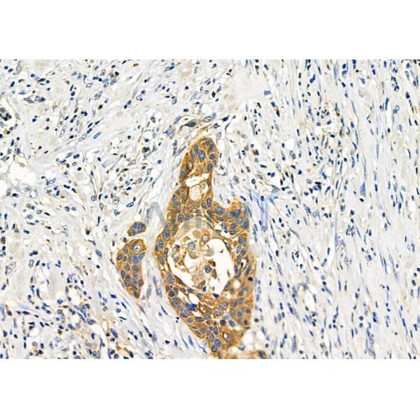 GPR133 Antibody - DF4947 at 1/100 staining Human esophageal cancer by IHC-P.
