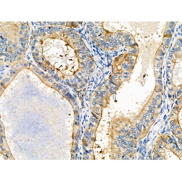 ARF6 Antibody - DF6170 at 1/100 staining Human colorectal cancer by IHC-P.