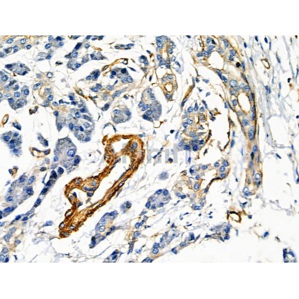 ARF6 Antibody - DF6170 at 1/100 staining Human pancreatic cancer and adjacent nomal tissues by IHC-P.