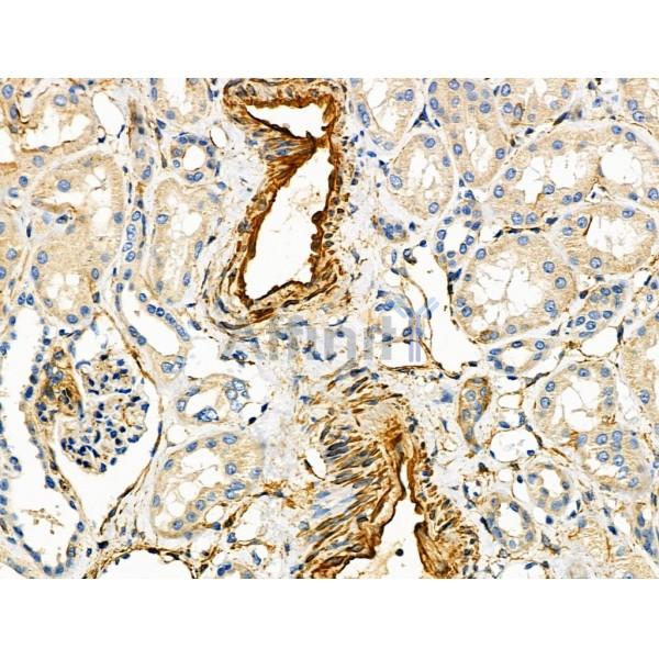 ARF6 Antibody - DF6170 at 1/100 staining Human kidney cancer and adjacent normal tissues by IHC-P.