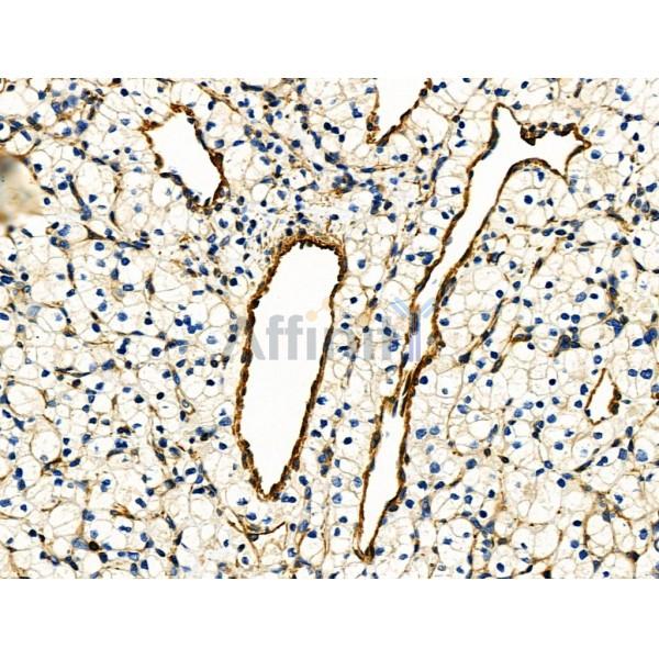 ARF6 Antibody - DF6170 at 1/100 staining Human kidney cancer by IHC-P.