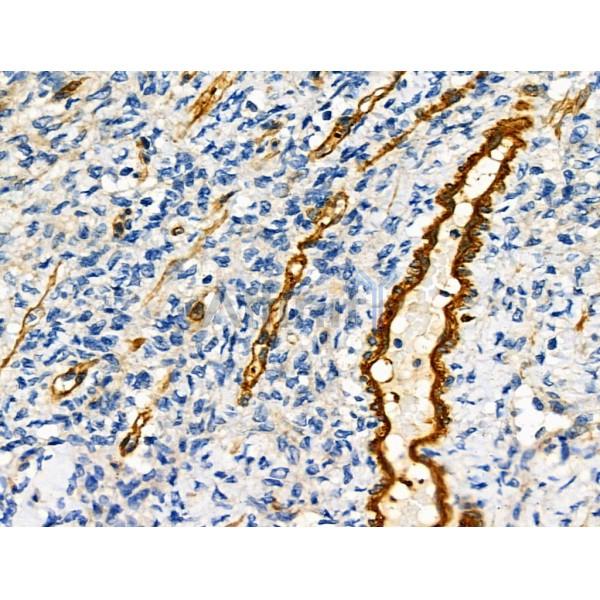 ARF6 Antibody - DF6170 at 1/100 staining Human ovarian cancer and adjacent normal tissues by IHC-P.