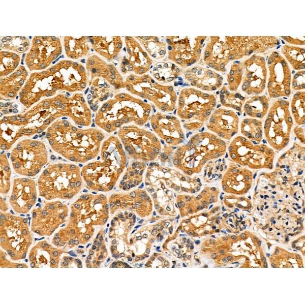 NCK1 Antibody - DF6181 at 1/100 staining Human kidney cancer and adjacent normal tissues by IHC-P.