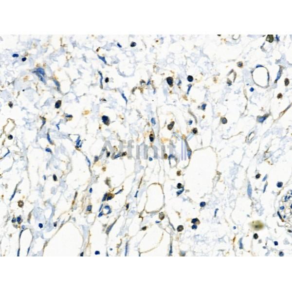 IRF4 Antibody - DF6198 at 1/100 staining Human pancreatic cancer by IHC-P.