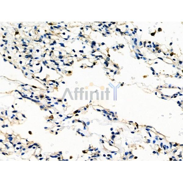 IRF4 Antibody - DF6198 at 1/100 staining Human kidney cancer by IHC-P.