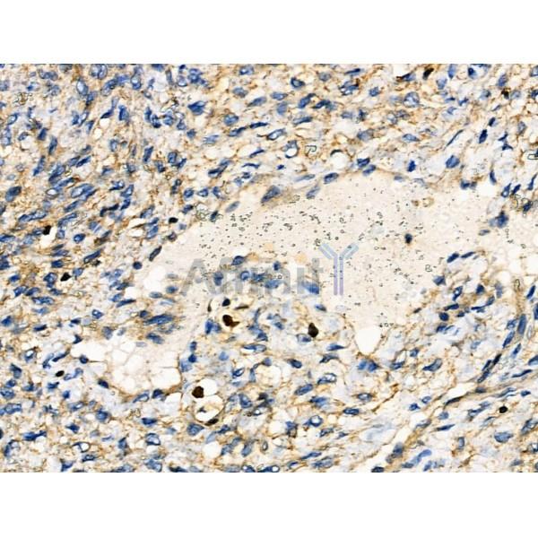 IRF4 Antibody - DF6198 at 1/100 staining Human ovarian cancer and adjacent normal tissues by IHC-P.