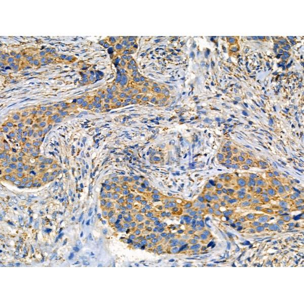 EpCAM Antibody - DF6311 at 1/100 staining Human mammary cancer by IHC-P.