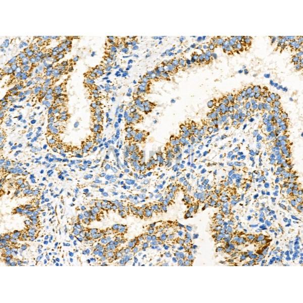 EpCAM Antibody - DF6311 at 1/100 staining Human prostate cancer by IHC-P.
